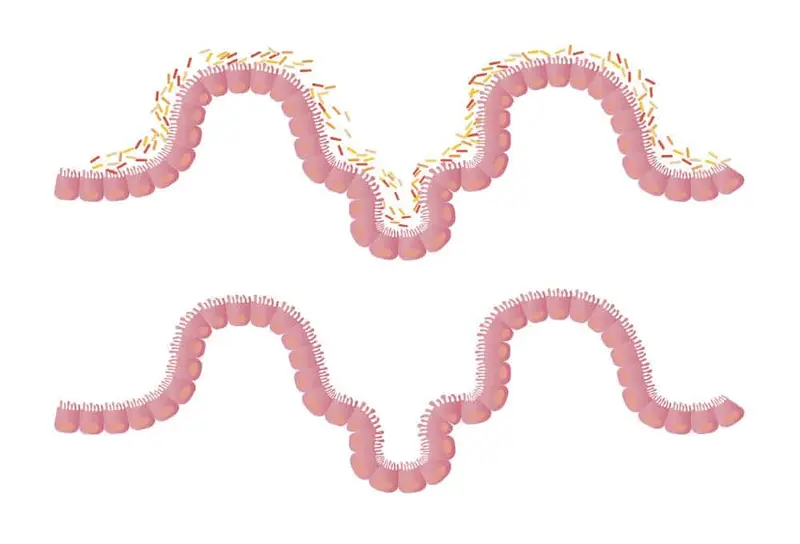 Transplantation de microbe fécal (FMT)