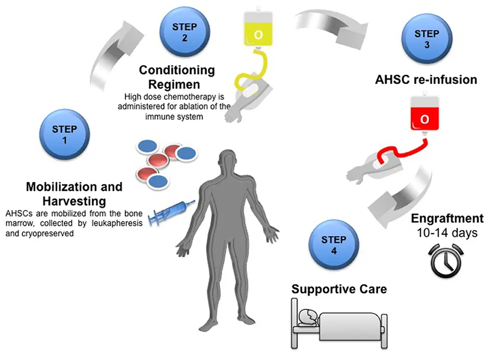 Une représentation graphique de la transplantation de cellules souches chez un patient atteint de sclérose en plaques