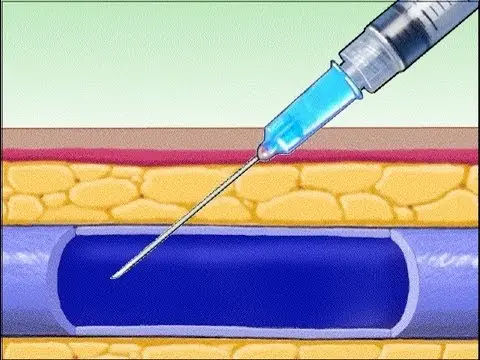 Injection intraveineuse
