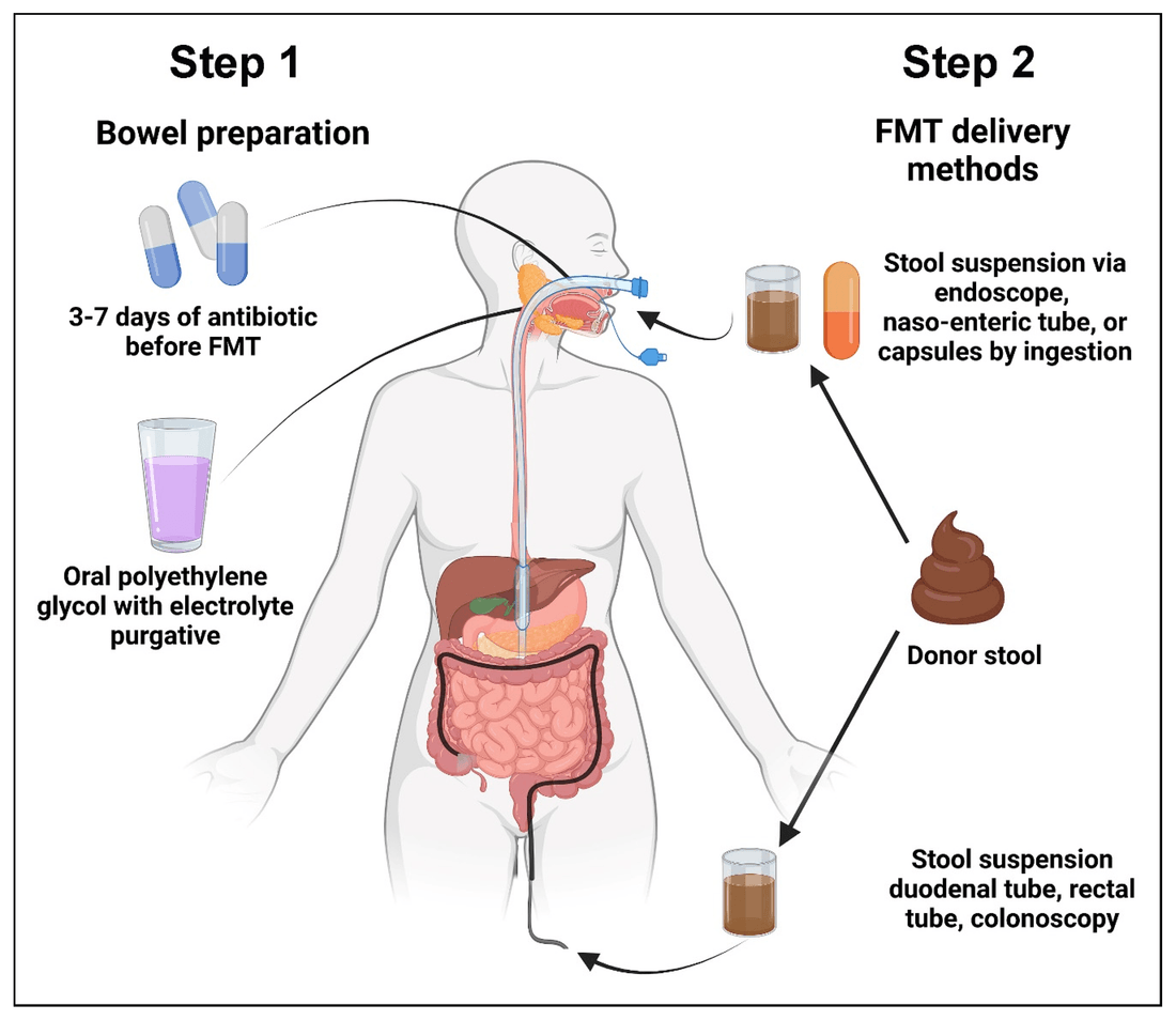 Les deux étapes d'une transplantation de microbiote fécal : préparation intestinale et voies d'administration de la TMF